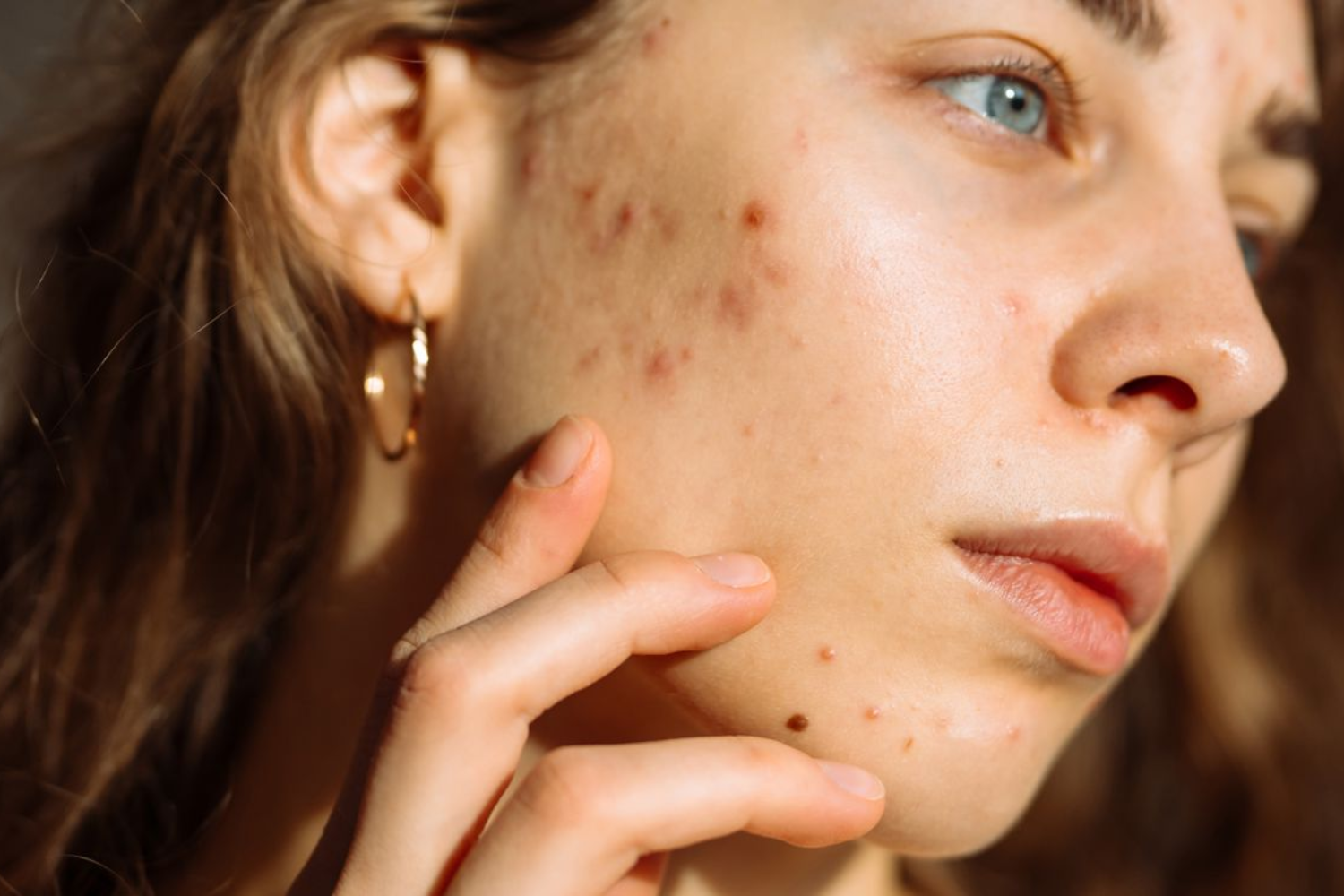 Acne & Acne Scar Recovery Package in Vijayawada | Acne Treatment & Scar Reduction Solutions