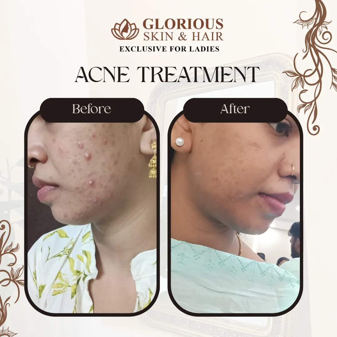 Acne Treatment in Vijayawada | Pimples & Acne Scar Treatment
