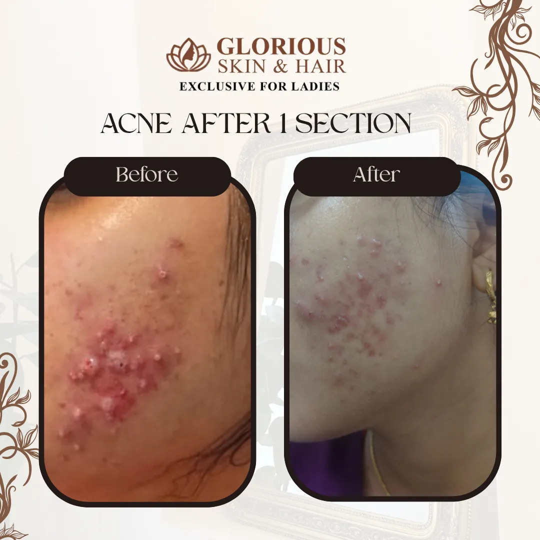 Before and After Acne Treatment Results at Glorious Skin & Hair Vijayawada