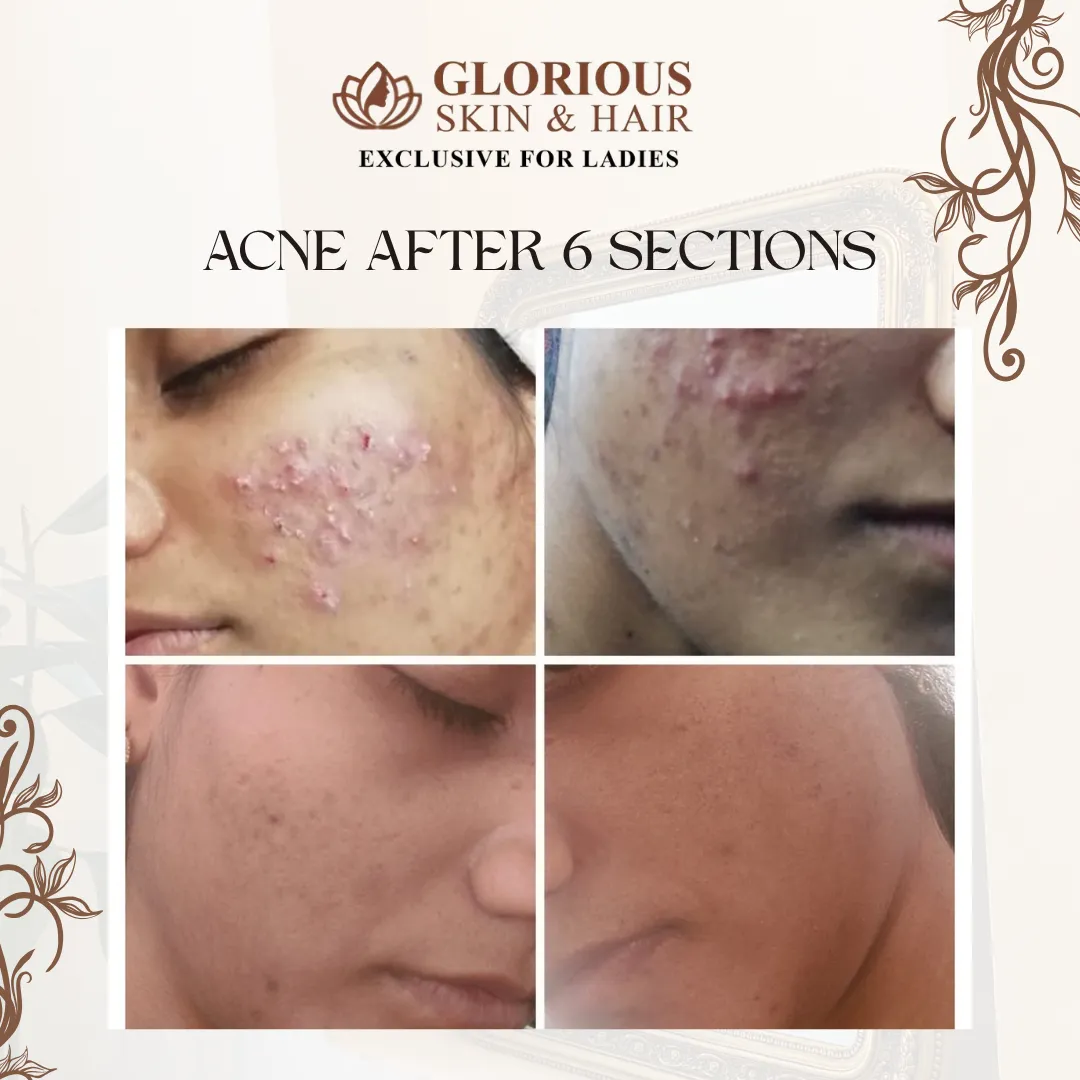 Clear, Healthy & Acne-Free Skin Starts Here