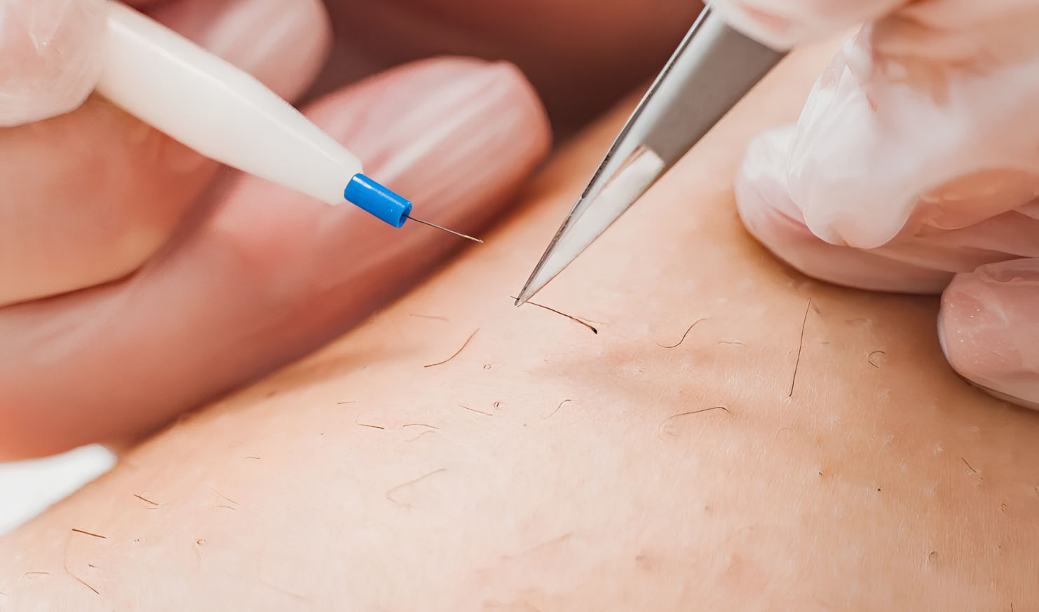 Electrolysis Hair Removal in Vijayawada | Permanent Unwanted Hair Removal Treatment
