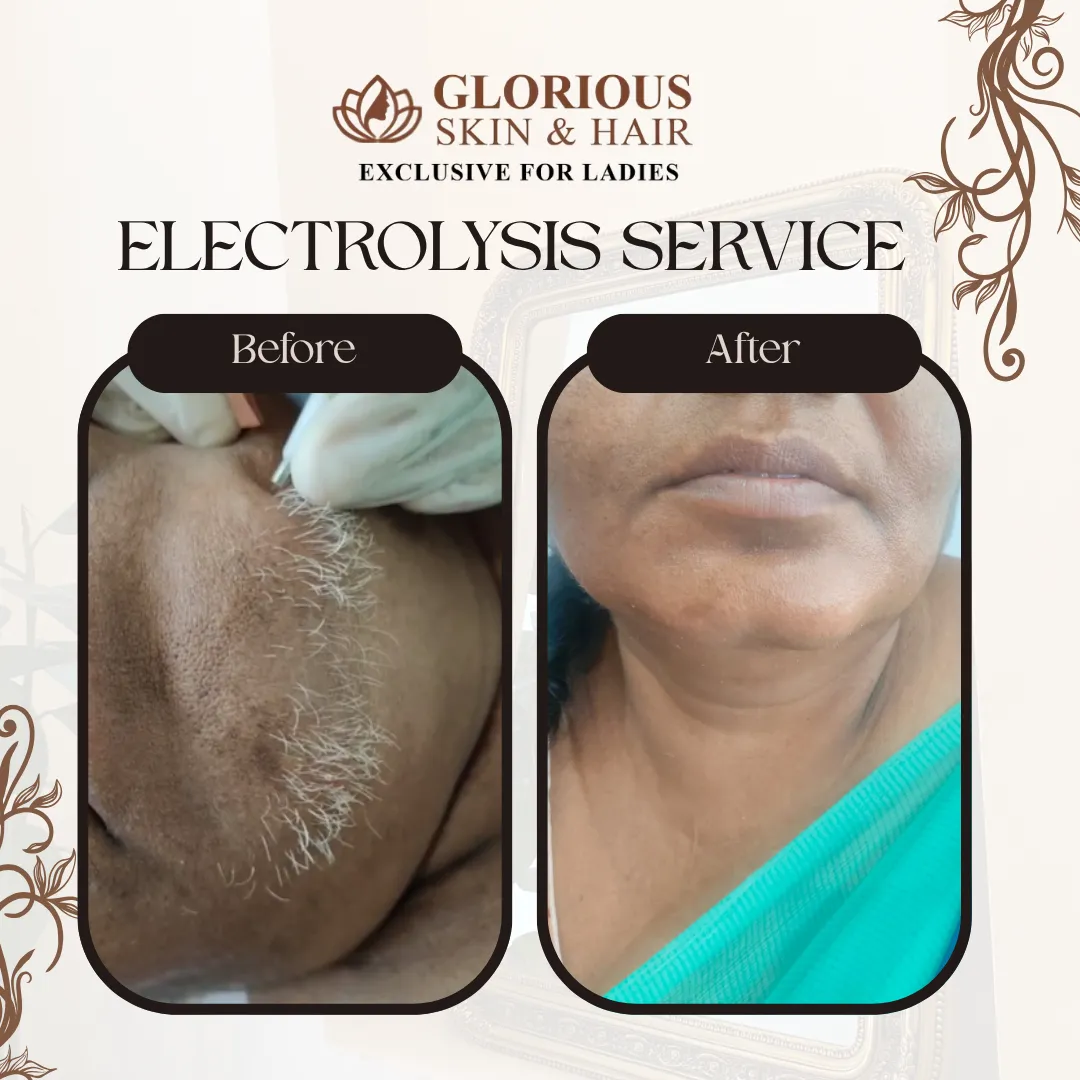 Electrolysis Hair Removal in Vijayawada | Permanent Hair Removal Treatment